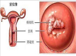 宫颈癌前病变