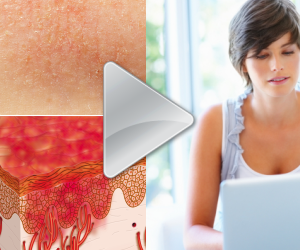 Watch videos about Eczema