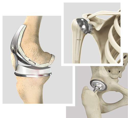 Total Joint Replacement Home