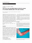 Research paper thumbnail of The use of a free and pedicled lateral arm flap for coverage of an extensive degloving injury of the upper extremity