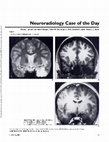 Research paper thumbnail of Neuroradiology case of the day. Dysembryoplastic neuroepithelial tumor