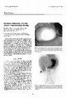 Research paper thumbnail of Duodenal Duplication Cyst with Massive Gastrointestinal Bleeding