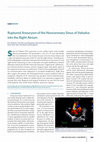 Research paper thumbnail of Ruptured aneurysm of the noncoronary sinus of valsalva into the right atrium