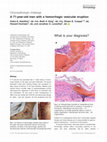 Research paper thumbnail of A 71-year-old man with a hemorrhagic vesicular eruption