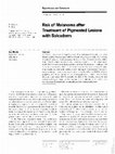 Research paper thumbnail of Risk of Melanoma after Treatment of Pigmented Lesions with Solcoderm