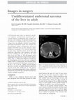 Research paper thumbnail of Undifferentiated embryonal sarcoma of the liver in adult