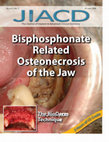 Research paper thumbnail of Successful Management of a Severe Case of Bisphosphonates Related Osteonecrosis of the Jaw in a Multiple Myeloma Patient