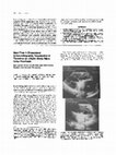 Research paper thumbnail of Real-time 2-dimensional echocardiographic visualization of thrombus on a Björk-Shiley mitral valve prosthesisEmergency cesarean section and mitral valve replacement in late pregnancy