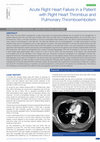 Research paper thumbnail of Acute Right Heart Failure in a Patient with Right Heart Thrombus and Pulmonary Thromboembolism