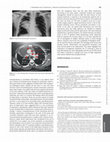 Research paper thumbnail of eComment. Aortic aneurysms secondary to tuberculosis