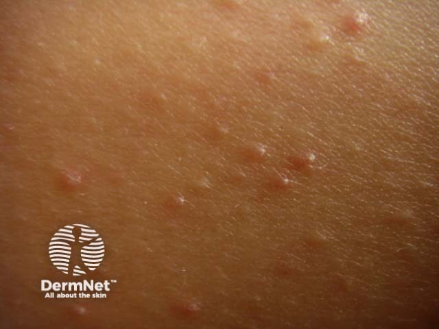 Keratosis pilaris