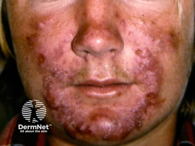 Pyoderma faciale, rosacea fulminans