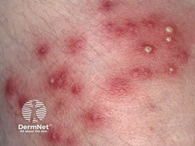 Superficial bacterial folliculitis