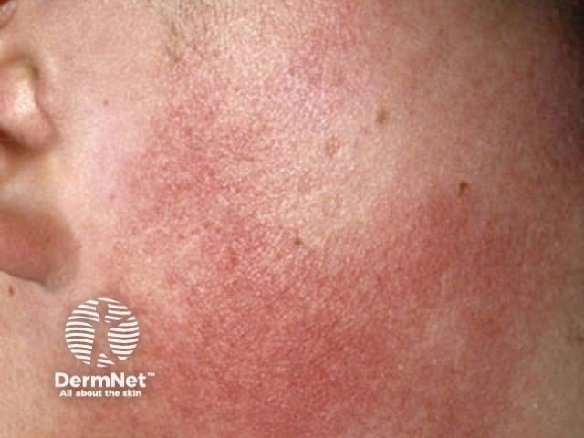 Keratosis pilaris rubra faciei