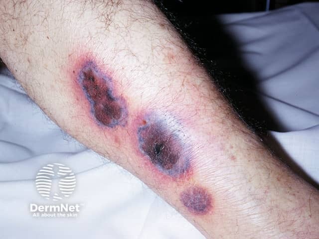 Ecthyma gangrenosum