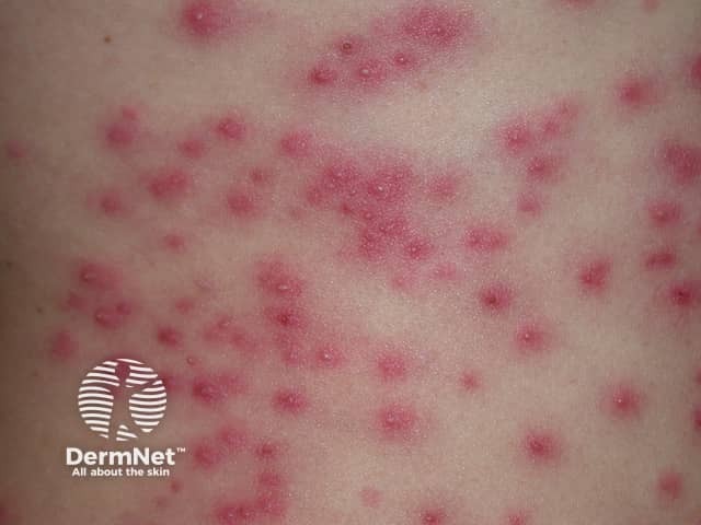 Pseudomonas folliculitis