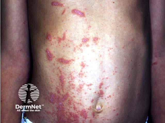 Grevillea dermatitis