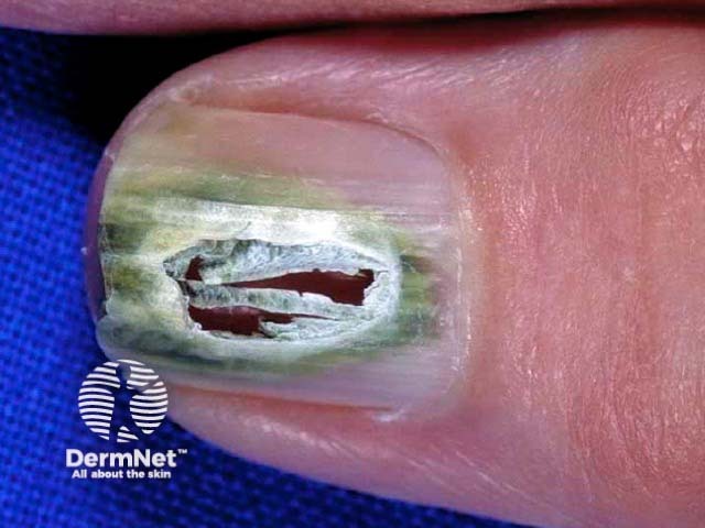 Green nail due to pseudomonas infection