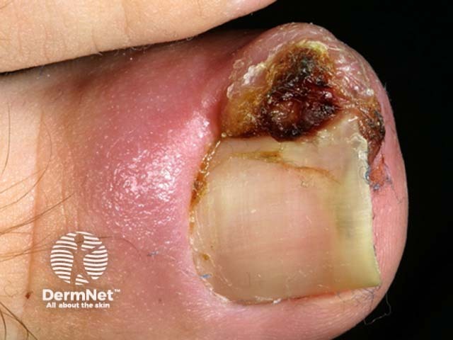 Ingrown toenail