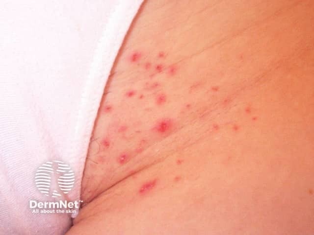 Folliculitis after waxing