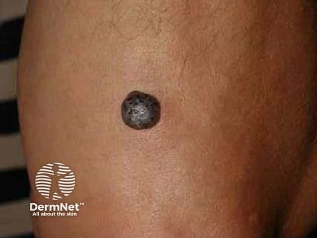 Cherry angioma resembling nodular melanoma