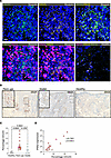 Type I IFN expression correlates with pDC infiltration in acute flare-ups o