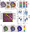 IGF-1 alters global transcriptomic profile of coronary plaque.