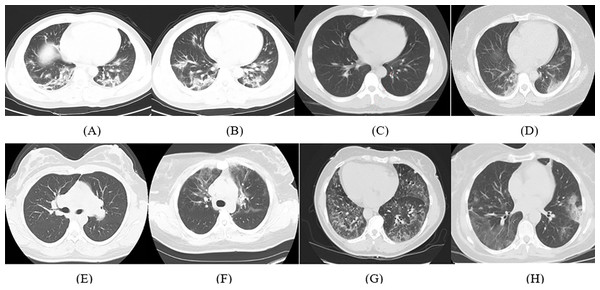 Samples of CT images from the dataset; (A–D) COVID-19 CT images and (E–H) non-COVID-19 CT images.