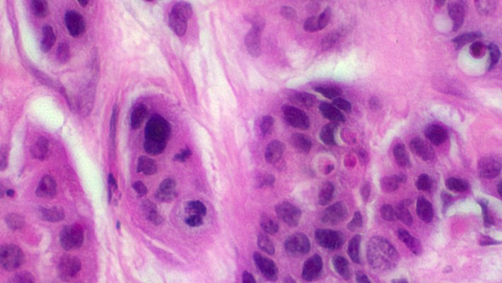 A close-up microscopy image of a breast cancer sample that is stained purple shows many details.