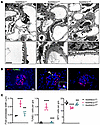 Podocyte overexpression of RARRESWT induces podocyte injury and loss.