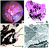 Endoscopic and histologic images of Randall’s plaques in CaOx patients. In