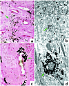 Crystalline deposits on interstitial collagen. In (a) and (b), numerous sit