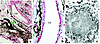 Accumulation of interstitial crystal deposits. In (a) and (b), extensive ac