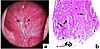 Endoscopic and histologic images of Randall’s plaques in intestinal bypass