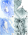 Pattern of intraluminal crystal deposition in medullary tissue of bypass pa