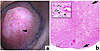 Endoscopic and crystal deposition in papillary tissue of non–stone formers.