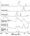 μ-FTIR spectra of crystal deposits in CaOx and intestinal-bypass patients.