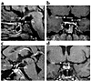 Neuroimaging studies of the patient with the HESX1(I26T) mutation (a and b)