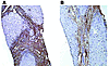 Reversibility of liver fibrosis in a patient with chronic hepatitis B virus