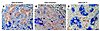 Cholangiocyte populations undergoing EMT during biliary fibrosis in humans