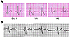 Cardiac phenotype of PFHBI patients.