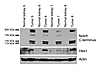 Evidence of Notch activation in angiomyolipomas.