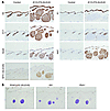 Nodular skin tumors arising from K15+ stem cells express BCC markers.