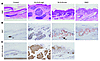 Low-level expression of GLI2ΔN gives rise to basaloid hamartomas instead of