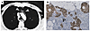 Lack of correlation of presence of a thymus shadow on computerized tomogram