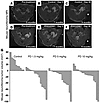 PD0325901 inhibits neurofibroma growth.