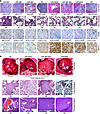 Effect of varying miR-664, miR-485-3p, and miR-495 expression on tumorigene