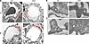 Podocyte foot process effacement in pod-Dnm-DKO mice.