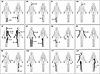 Dermomyotomal distribution of HO in POH.