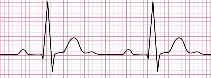 ECG before